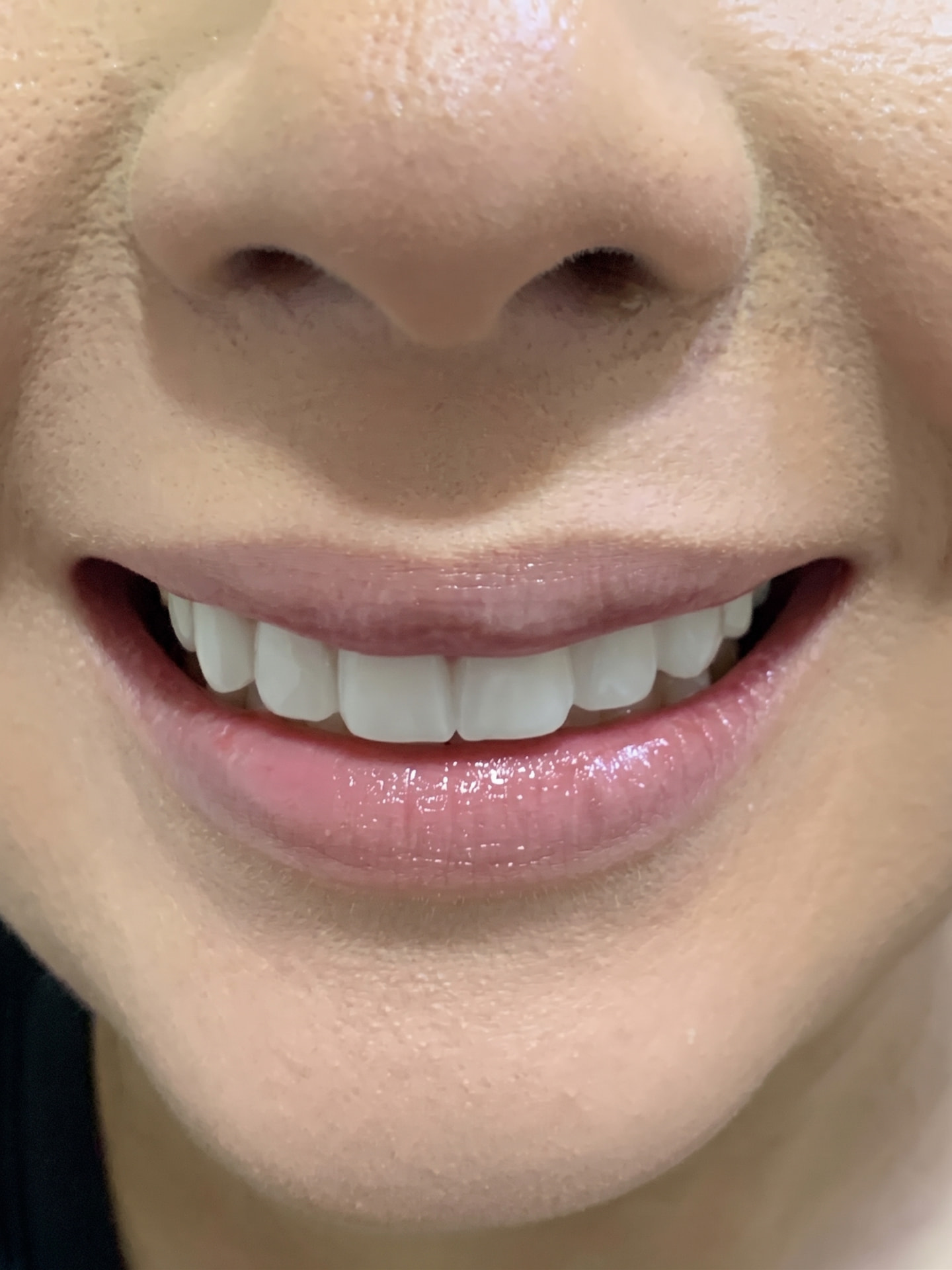 Sonrisa después de las carillas de porcelana